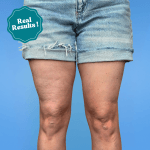 LiftNow™ Patches- Say goodbye to sagging skin and cellulite instantly