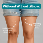 LiftNow™ Patches- Say goodbye to sagging skin and cellulite instantly